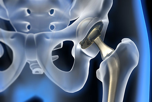 los angeles hip replacement lawsuit injuries