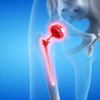 3d rendered medically accurate illustration of a painful hip replacement