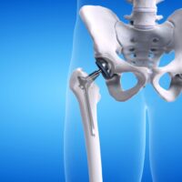 3d rendered medically accurate illustration of a hip replacement