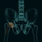 Human skeleton with a metal hip prosthesis concept arthroplasty