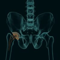 Human skeleton with a metal hip prosthesis concept arthroplasty