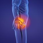 hip replacement attorney