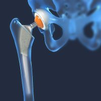 hip replacement